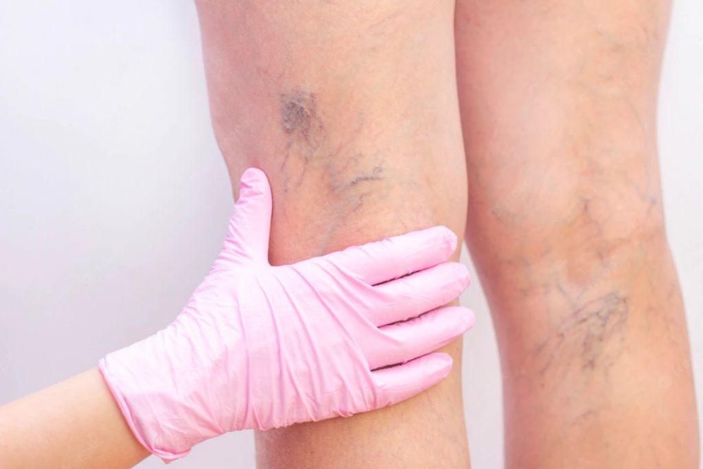 Vein in Obese Person