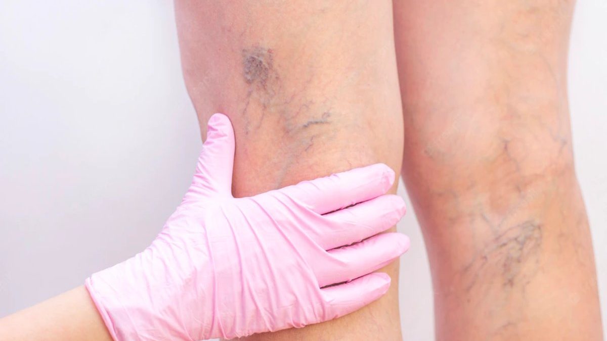 How to Find a Vein in Obese Person?