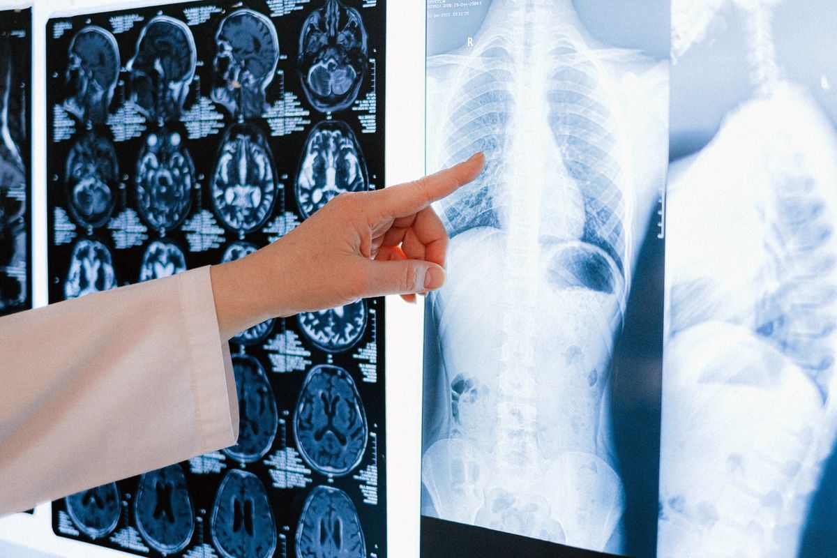 How to Use AI to Support Early Mesothelioma Detection in 3 Steps 1